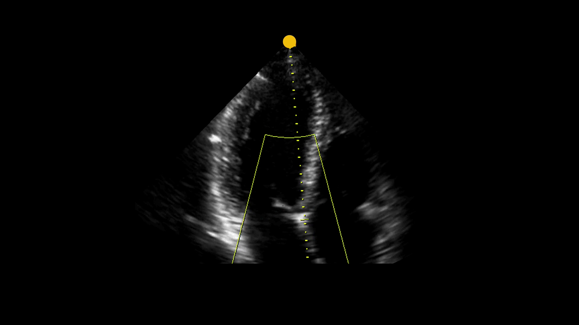 Left Ventricular Strain in Ultrasound